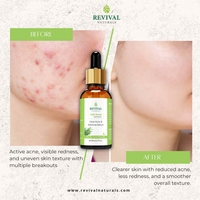 2-Step Acne Clearing System