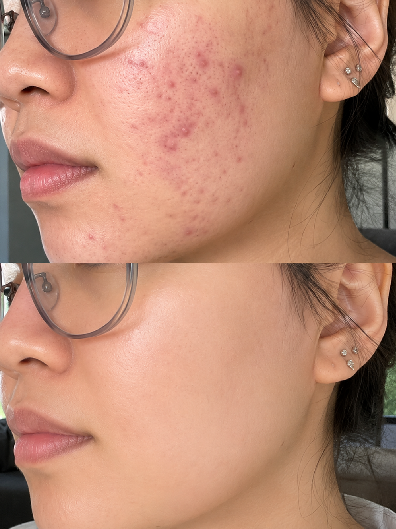 Redness Pores